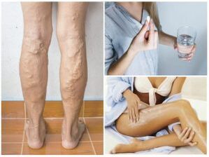 Varices sur les jambes et les méthodes de traitement