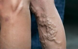 Varices sur les jambes