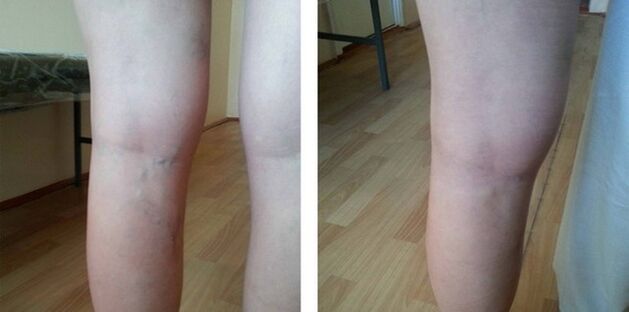 varices sur les jambes
